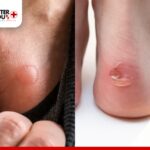 Diabetic blisters