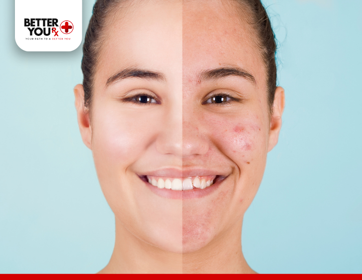 Understanding acne formation thumbnail