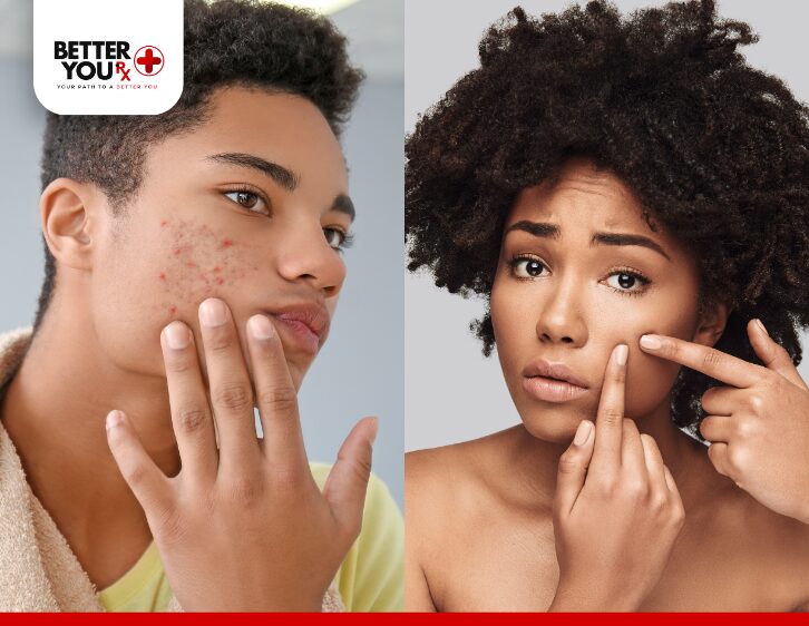 Teenagers examining acne on their faces, highlighting common skin concerns | Better You Rx