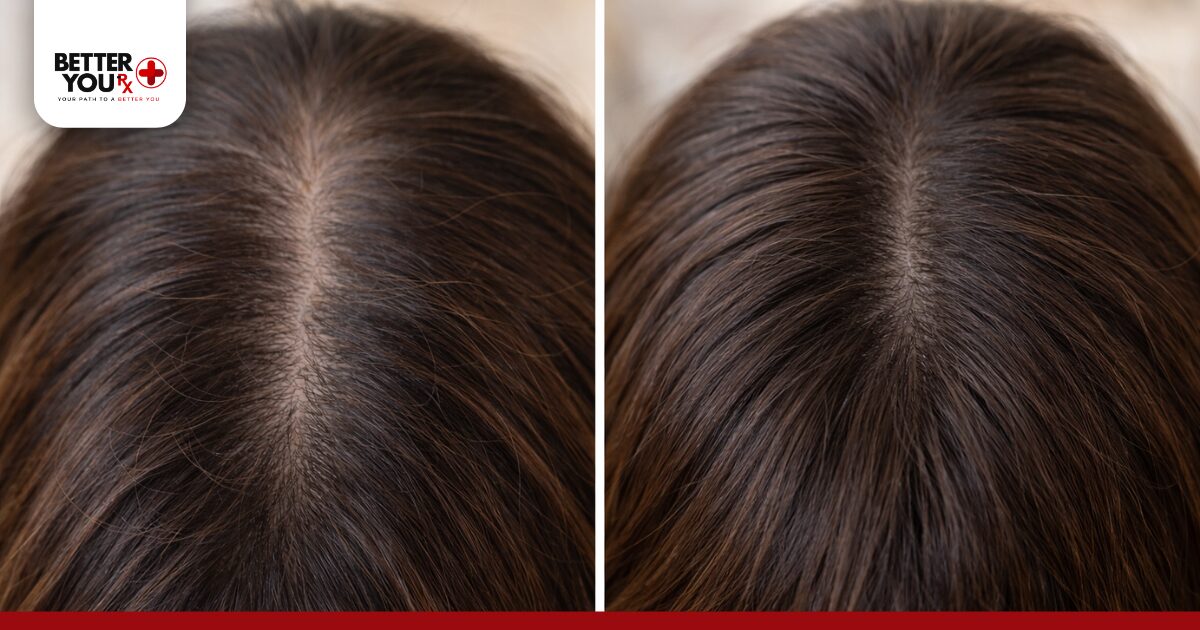 How Common Is Hair Loss with Retatrutide